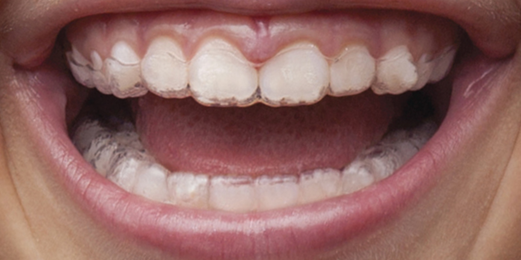 Invisalign aligners