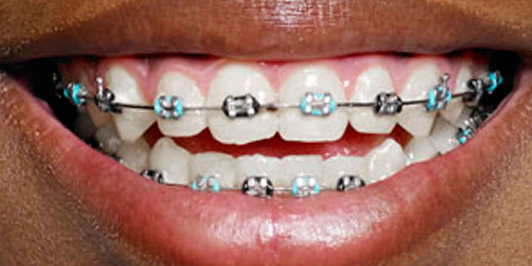 Braces vs. Invisalign® – Orthodontist Locust Valley – Glen Cove